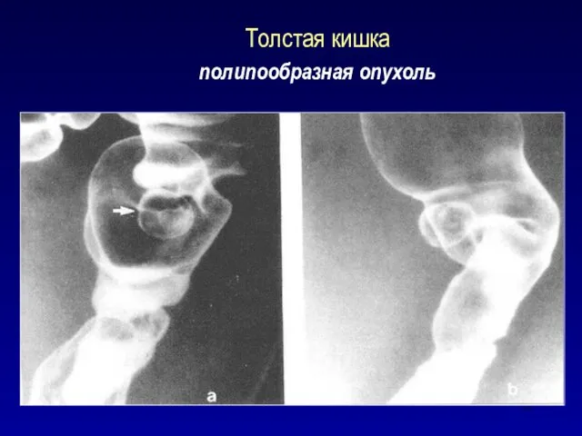 Толстая кишка полипообразная опухоль