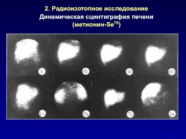 2. Радиоизотопное исследование Динамическая сцинтиграфия печени (метионин-Se75)