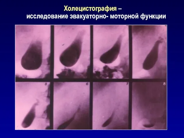 Холецистография – исследование эвакуаторно- моторной функции