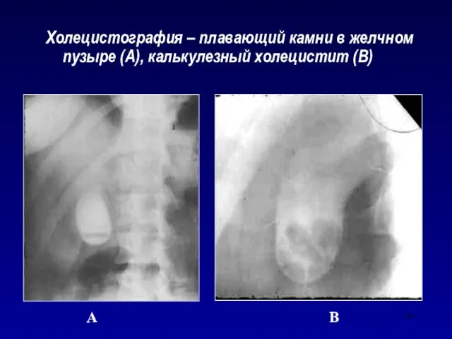 Холецистография – плавающий камни в желчном пузыре (А), калькулезный холецистит (В) А В