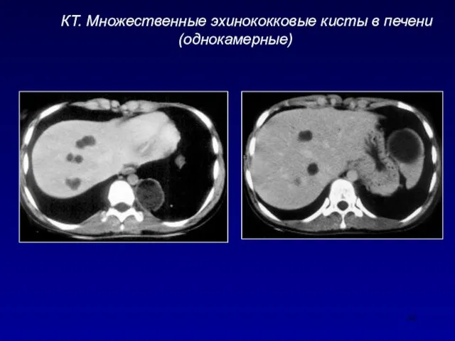 КТ. Множественные эхинококковые кисты в печени (однокамерные)