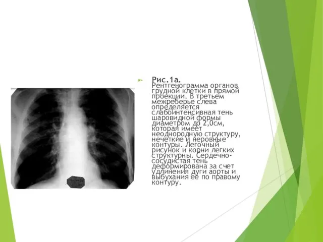 Рис.1а. Рентгенограмма органов грудной клетки в прямой проекции. В третьем