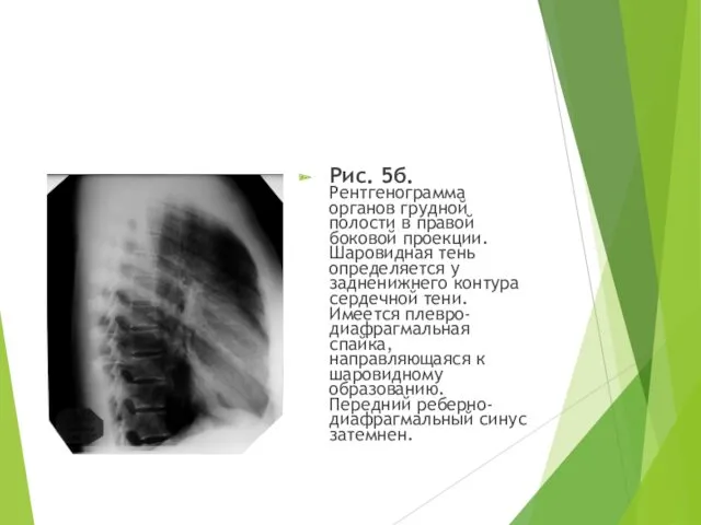 Рис. 5б. Рентгенограмма органов грудной полости в правой боковой проекции.