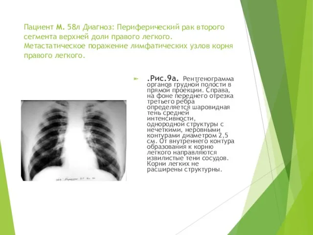 Пациент М. 58л Диагноз: Периферический рак второго сегмента верхней доли