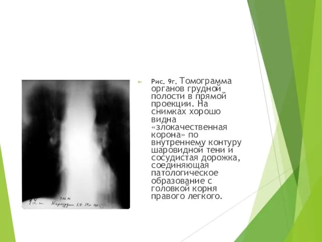 Рис. 9г. Томограмма органов грудной полости в прямой проекции. На