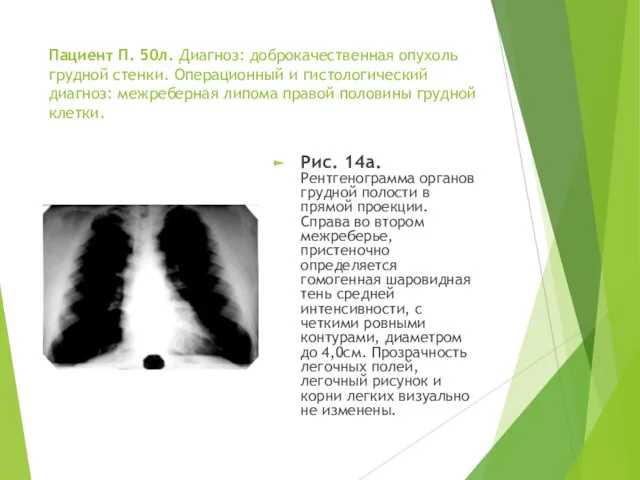 Пациент П. 50л. Диагноз: доброкачественная опухоль грудной стенки. Операционный и