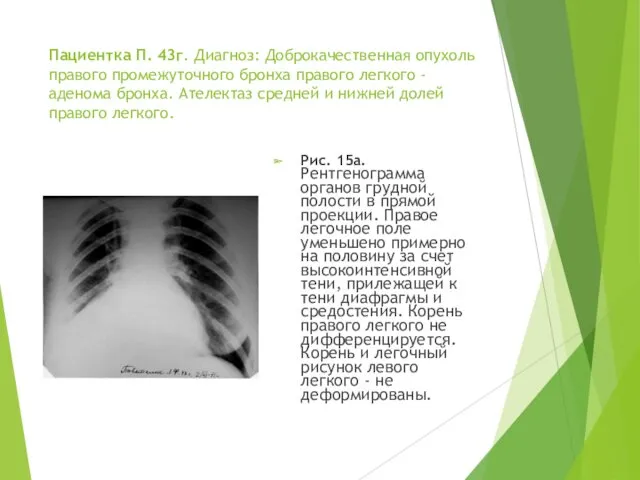 Пациентка П. 43г. Диагноз: Доброкачественная опухоль правого промежуточного бронха правого