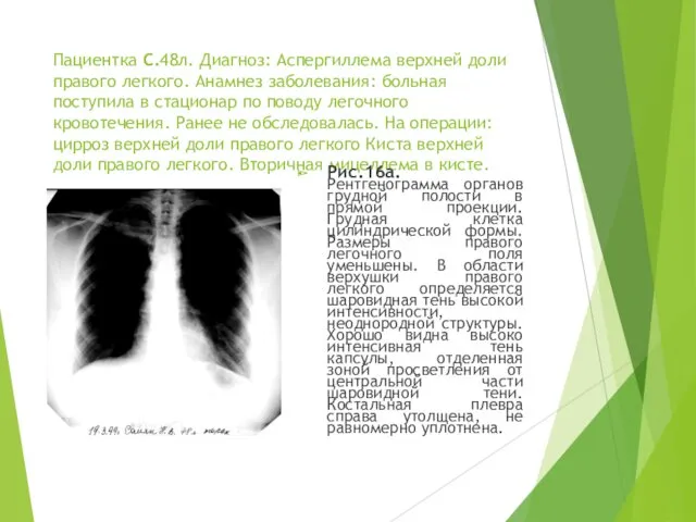 Пациентка С.48л. Диагноз: Аспергиллема верхней доли правого легкого. Анамнез заболевания:
