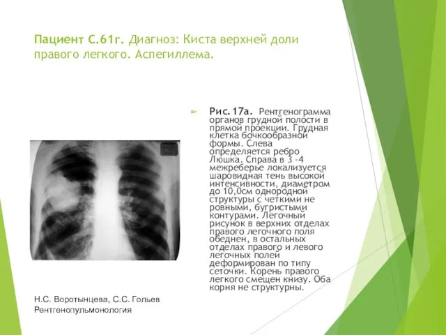 Пациент С.61г. Диагноз: Киста верхней доли правого легкого. Аспегиллема. Рис.17а.