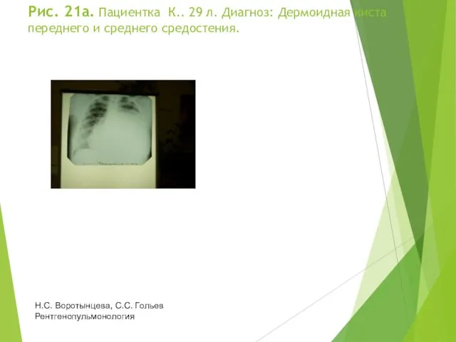 Рис. 21а. Пациентка К.. 29 л. Диагноз: Дермоидная киста переднего