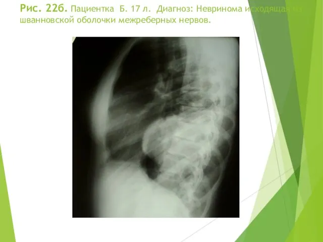 Рис. 22б. Пациентка Б. 17 л. Диагноз: Невринома исходящая из шванновской оболочки межреберных нервов.