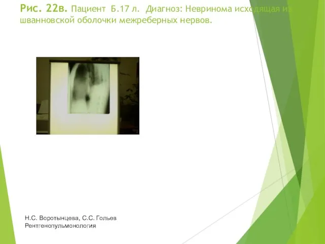 Рис. 22в. Пациент Б.17 л. Диагноз: Невринома исходящая из шванновской