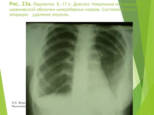 Рис. 23а. Пациентка Б. 17 л. Диагноз: Невринома исходящая из