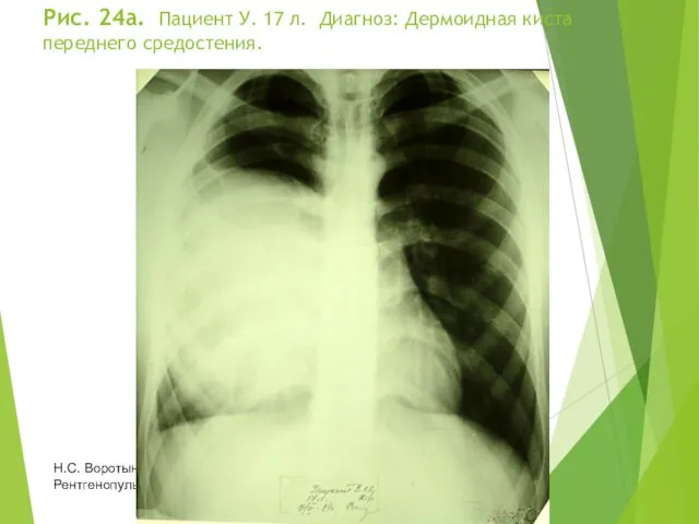 Рис. 24а. Пациент У. 17 л. Диагноз: Дермоидная киста переднего средостения. Н.С. Воротынцева, С.С. Гольев Рентгенопульмонология