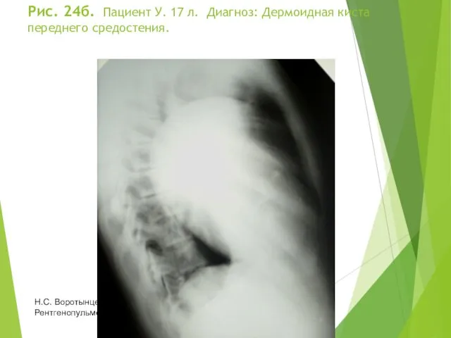 Рис. 24б. Пациент У. 17 л. Диагноз: Дермоидная киста переднего средостения. Н.С. Воротынцева, С.С. Гольев Рентгенопульмонология