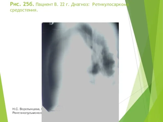 Рис. 25б. Пациент В. 22 г. Диагноз: Ретикулосаркома средостения. Н.С. Воротынцева, С.С. Гольев Рентгенопульмонология