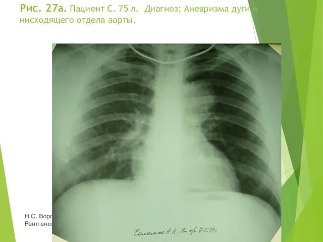 Рис. 27а. Пациент С. 75 л. Диагноз: Аневризма дуги и