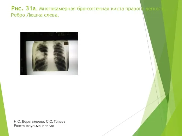 Рис. 31а. Многокамерная бронхогенная киста правого легкого. Ребро Люшка слева. Н.С. Воротынцева, С.С. Гольев Рентгенопульмонология