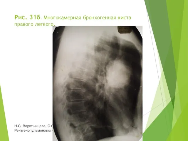 Рис. 31б. Многокамерная бронхогенная киста правого легкого. Н.С. Воротынцева, С.С. Гольев Рентгенопульмонология