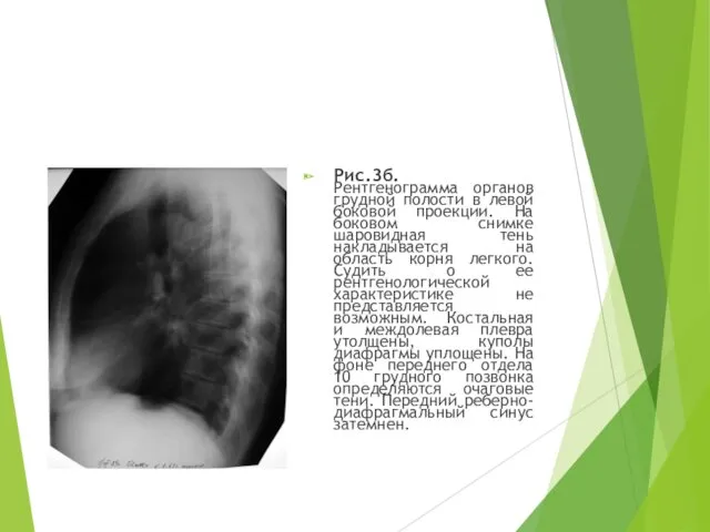 Рис.3б. Рентгенограмма органов грудной полости в левой боковой проекции. На