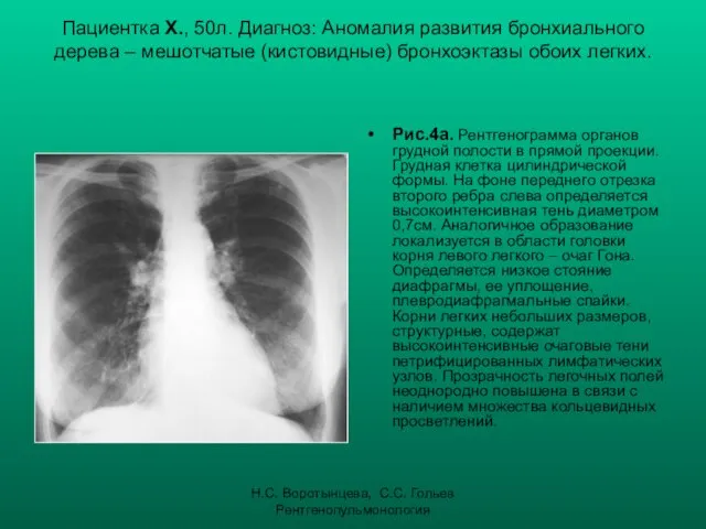 Н.С. Воротынцева, С.С. Гольев Рентгенопульмонология Пациентка Х., 50л. Диагноз: Аномалия развития бронхиального дерева