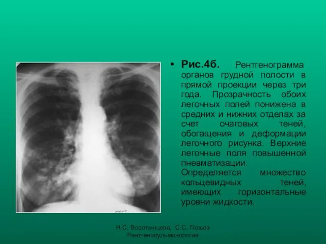 Н.С. Воротынцева, С.С. Гольев Рентгенопульмонология Рис.4б. Рентгенограмма органов грудной полости в прямой проекции