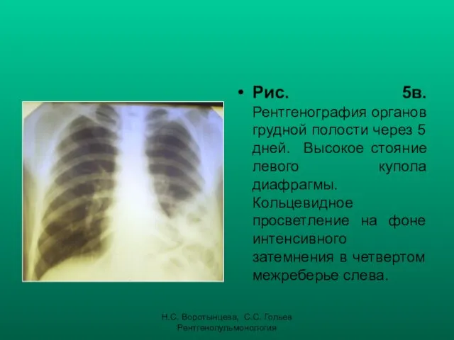 Н.С. Воротынцева, С.С. Гольев Рентгенопульмонология Рис. 5в. Рентгенография органов грудной полости через 5