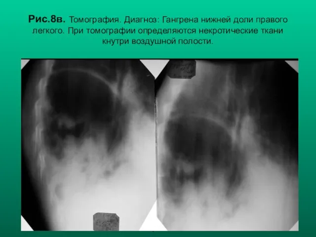 Н.С. Воротынцева, С.С. Гольев Рентгенопульмонология Рис.8в. Томография. Диагноз: Гангрена нижней доли правого легкого.