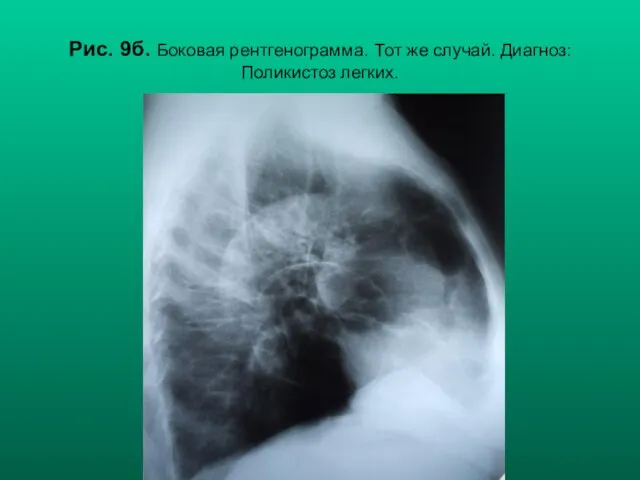 Н.С. Воротынцева, С.С. Гольев Рентгенопульмонология Рис. 9б. Боковая рентгенограмма. Тот же случай. Диагноз: Поликистоз легких.