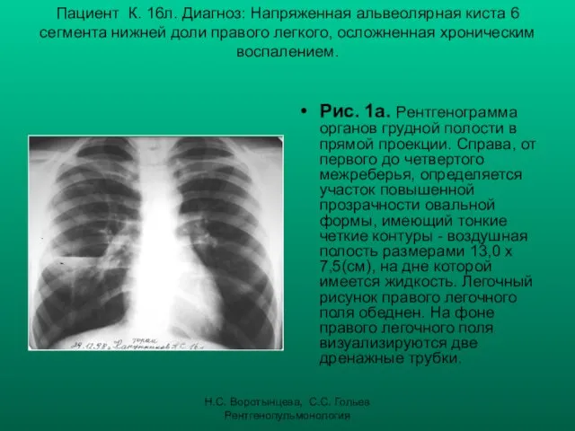 Н.С. Воротынцева, С.С. Гольев Рентгенопульмонология Пациент К. 16л. Диагноз: Напряженная альвеолярная киста 6