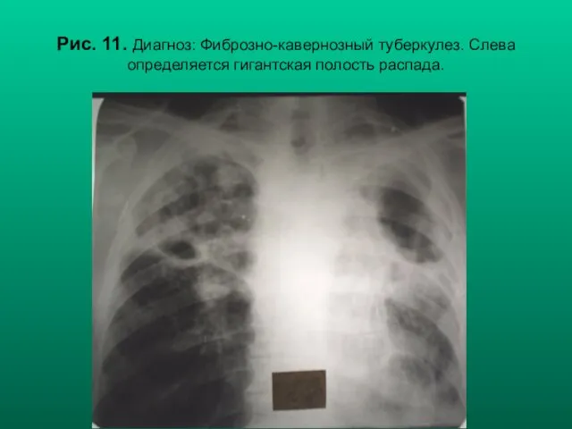 Н.С. Воротынцева, С.С. Гольев Рентгенопульмонология Рис. 11. Диагноз: Фиброзно-кавернозный туберкулез. Слева определяется гигантская полость распада.