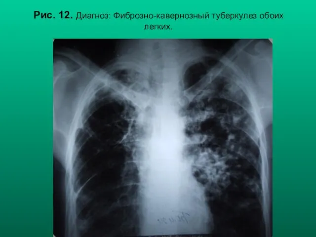 Н.С. Воротынцева, С.С. Гольев Рентгенопульмонология Рис. 12. Диагноз: Фиброзно-кавернозный туберкулез обоих легких.