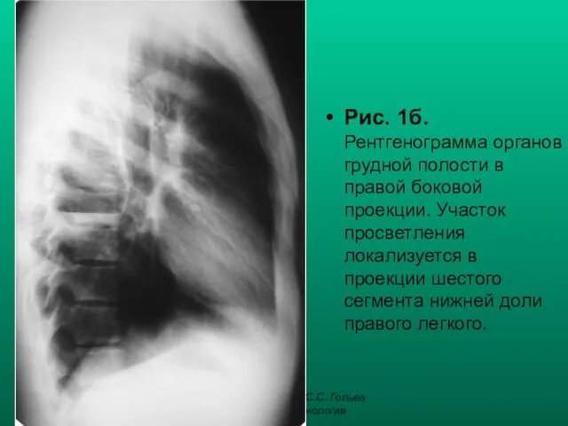 Н.С. Воротынцева, С.С. Гольев Рентгенопульмонология Рис. 1б. Рентгенограмма органов грудной полости в правой