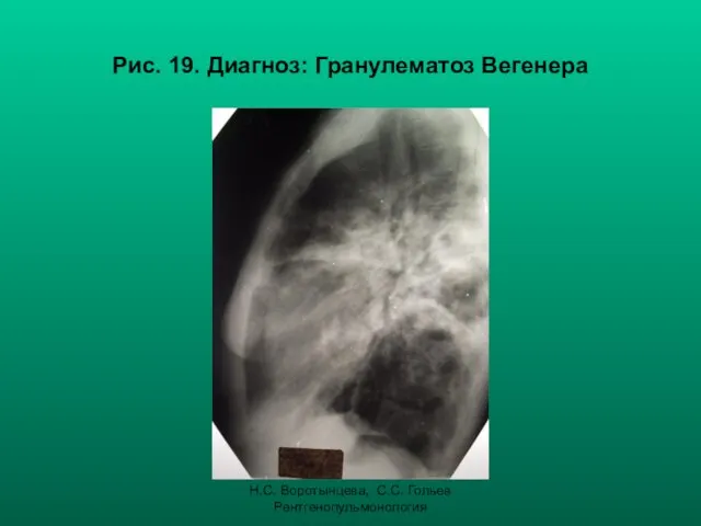 Н.С. Воротынцева, С.С. Гольев Рентгенопульмонология Рис. 19. Диагноз: Гранулематоз Вегенера