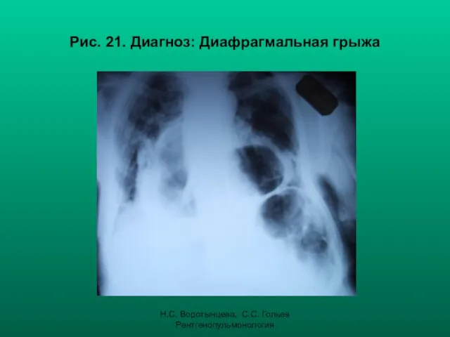 Н.С. Воротынцева, С.С. Гольев Рентгенопульмонология Рис. 21. Диагноз: Диафрагмальная грыжа