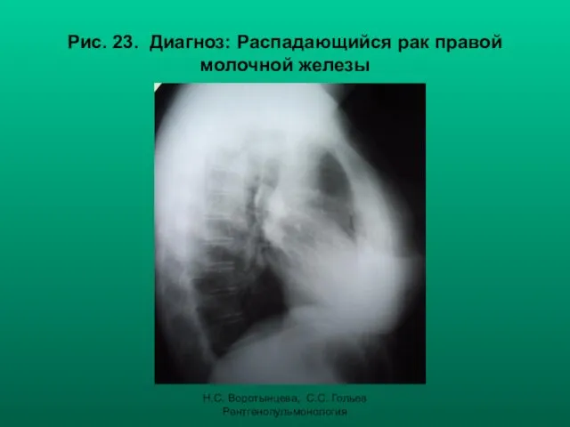 Н.С. Воротынцева, С.С. Гольев Рентгенопульмонология Рис. 23. Диагноз: Распадающийся рак правой молочной железы