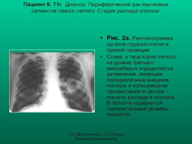 Н.С. Воротынцева, С.С. Гольев Рентгенопульмонология Пациент К. 71г. Диагноз: Периферический рак язычковых сегментов