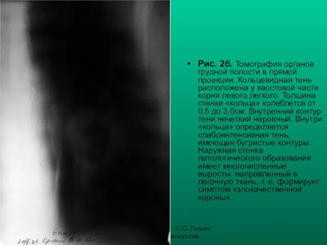 Н.С. Воротынцева, С.С. Гольев Рентгенопульмонология Рис. 2б. Томография органов грудной полости в прямой
