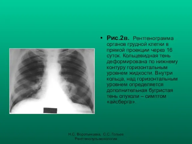 Н.С. Воротынцева, С.С. Гольев Рентгенопульмонология Рис.2в. Рентгенограмма органов грудной клетки в прямой проекции