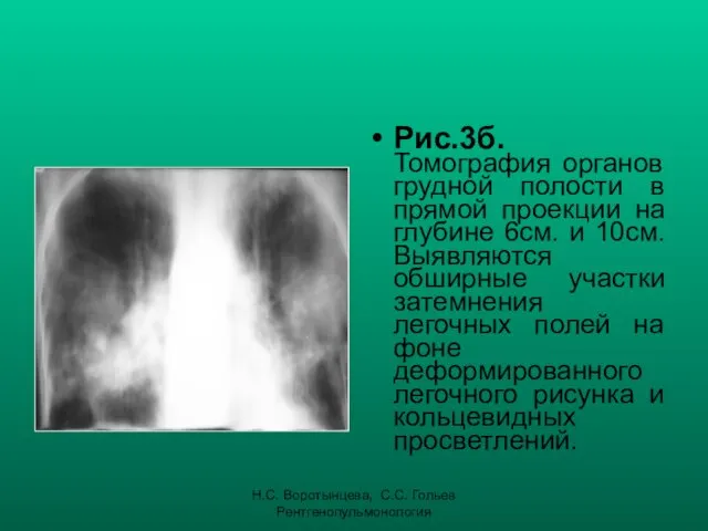 Н.С. Воротынцева, С.С. Гольев Рентгенопульмонология Рис.3б. Томография органов грудной полости в прямой проекции