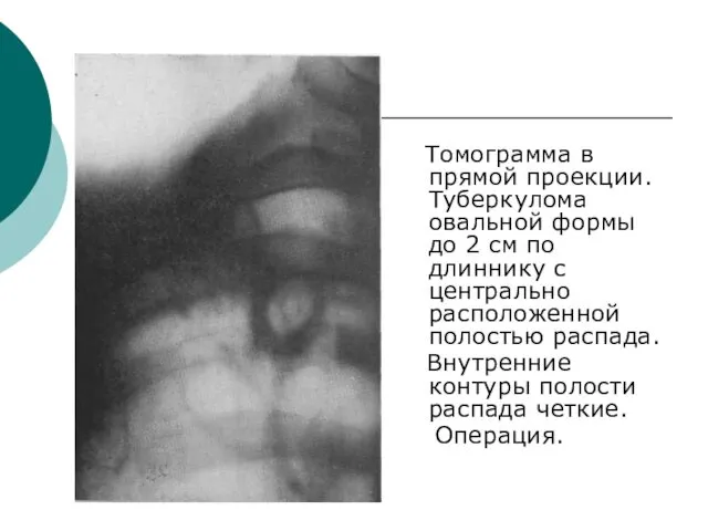 Томограмма в прямой проекции. Туберкулома овальной формы до 2 см