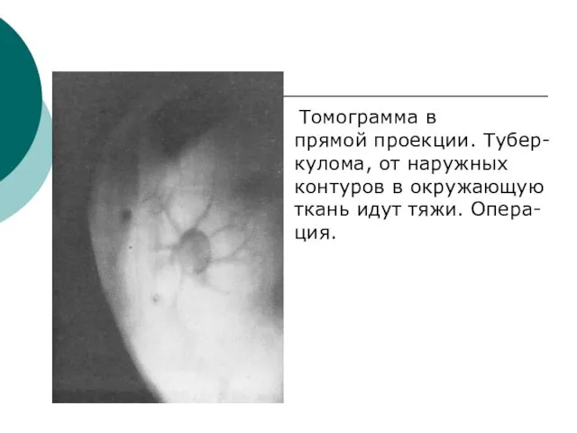 Томограмма в прямой проекции. Тубер- кулома, от наружных контуров в окружающую ткань идут тяжи. Опера- ция.