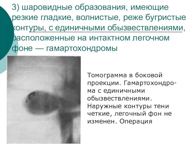 3) шаровидные образования, имеющие резкие гладкие, волнистые, реже бугристые контуры,