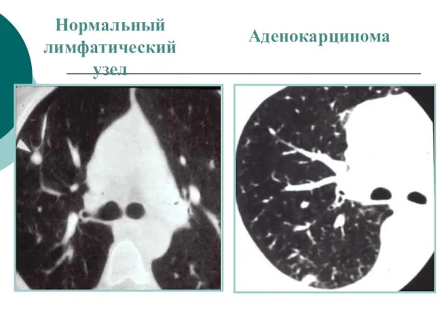 Нормальный лимфатический узел Аденокарцинома