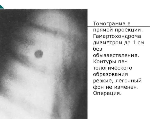 Томограмма в прямой проекции. Гамартохондрома диаметром до 1 см без