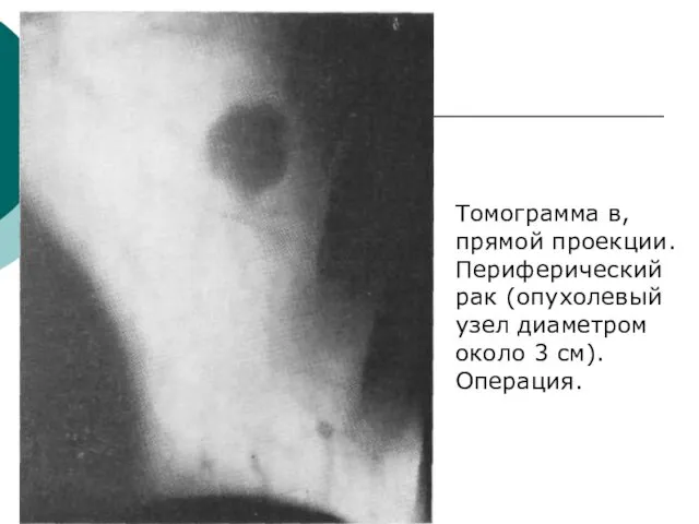 Томограмма в, прямой проекции. Периферический рак (опухолевый узел диаметром около 3 см). Операция.