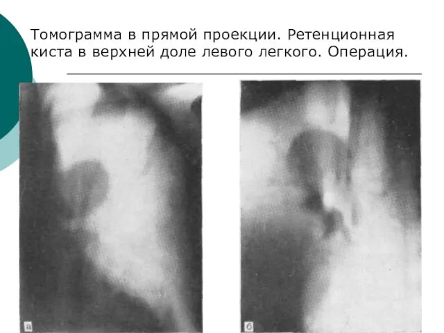 Томограмма в прямой проекции. Ретенционная киста в верхней доле левого легкого. Операция.