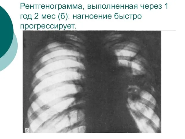 Рентгенограмма, выполненная через 1 год 2 мес (б): нагноение быстро прогрессирует.