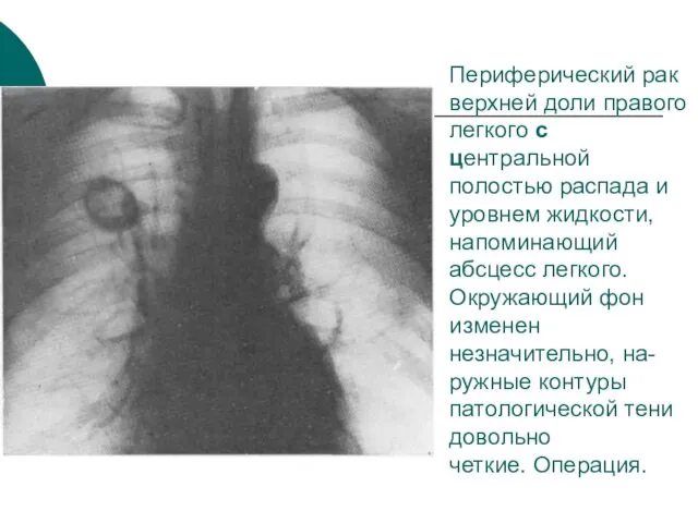 Периферический рак верхней доли правого легкого с центральной полостью распада