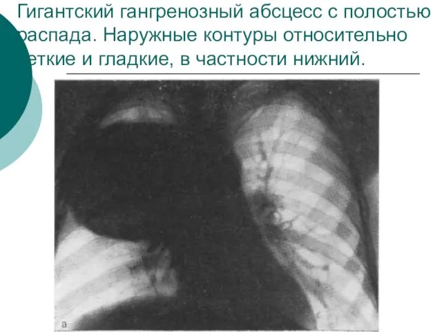 Гигантский гангренозный абсцесс с полостью распада. Наружные контуры относительно четкие и гладкие, в частности нижний.